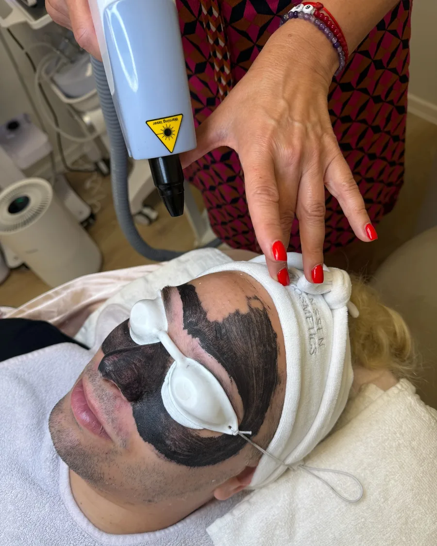 Carbon peeling kezelés: fekete maszk az arcon, védőszemüveg és lézer kézidarab a Beautyflow for Men szalonban